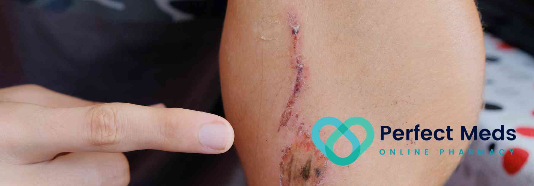 person pointing at wound on their arm